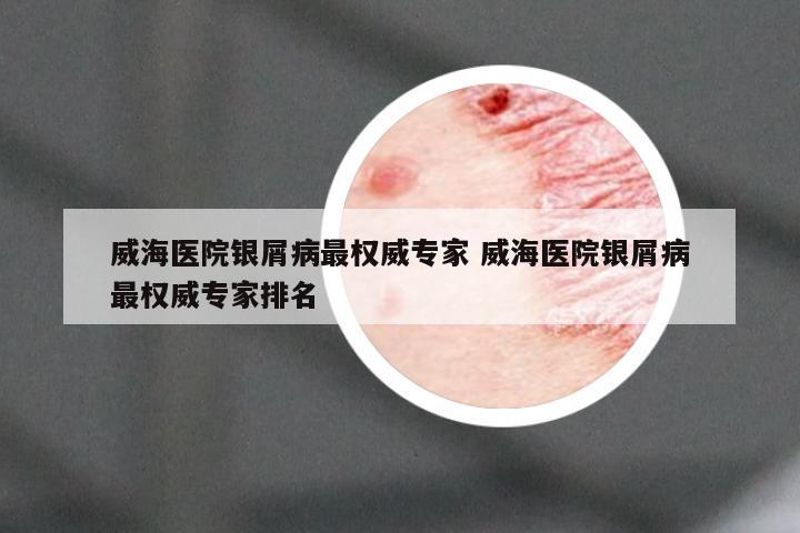 威海医院银屑病最权威专家 威海医院银屑病最权威专家排名