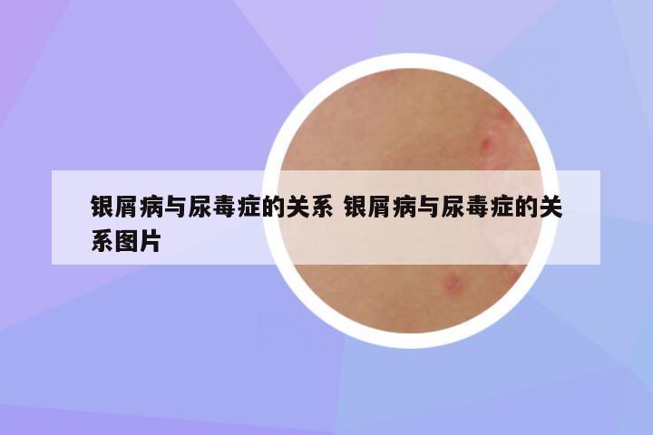 银屑病与尿毒症的关系 银屑病与尿毒症的关系图片