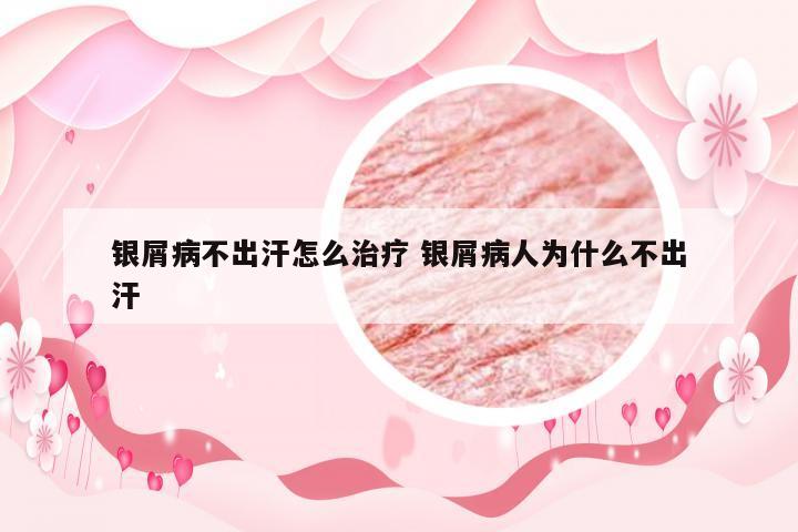 银屑病不出汗怎么治疗 银屑病人为什么不出汗