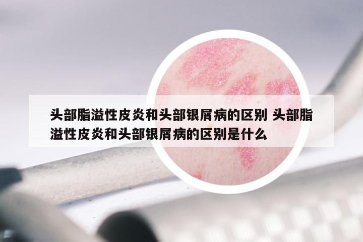 头部脂溢性皮炎和头部银屑病的区别 头部脂溢性皮炎和头部银屑病的区别是什么
