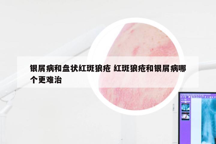 银屑病和盘状红斑狼疮 红斑狼疮和银屑病哪个更难治