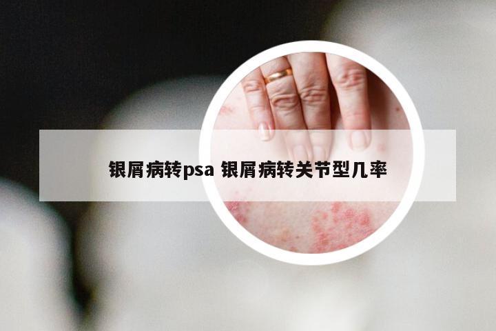 银屑病转psa 银屑病转关节型几率
