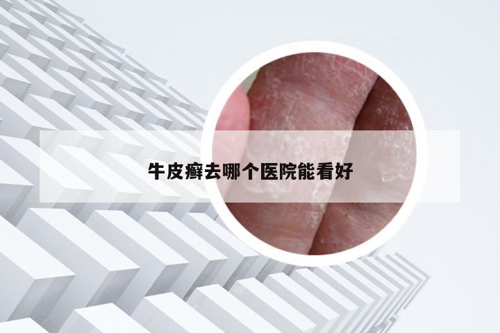 牛皮癣去哪个医院能看好
