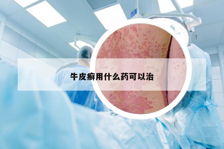 牛皮癣用什么药可以治