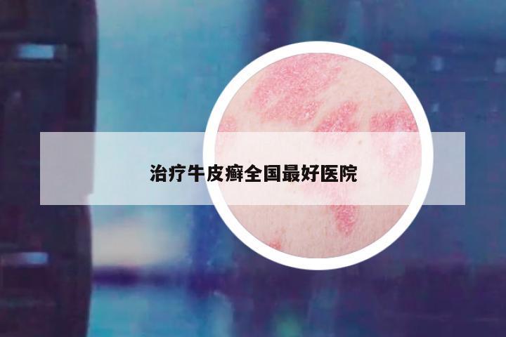 治疗牛皮癣全国最好医院