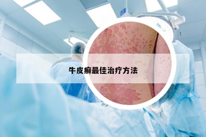 牛皮癣最佳治疗方法