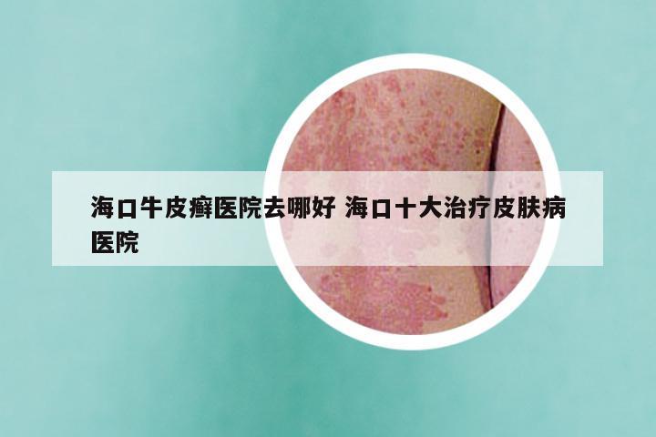 海口牛皮癣医院去哪好 海口十大治疗皮肤病医院