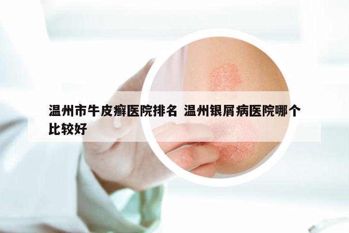 温州市牛皮癣医院排名 温州银屑病医院哪个比较好