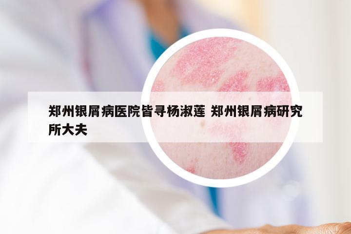 郑州银屑病医院皆寻杨淑莲 郑州银屑病研究所大夫