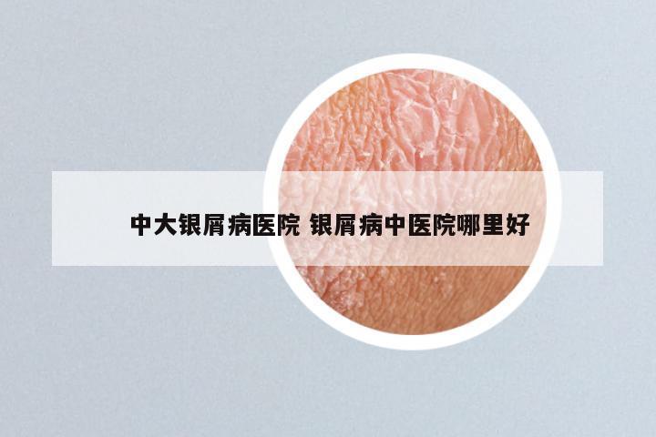 中大银屑病医院 银屑病中医院哪里好