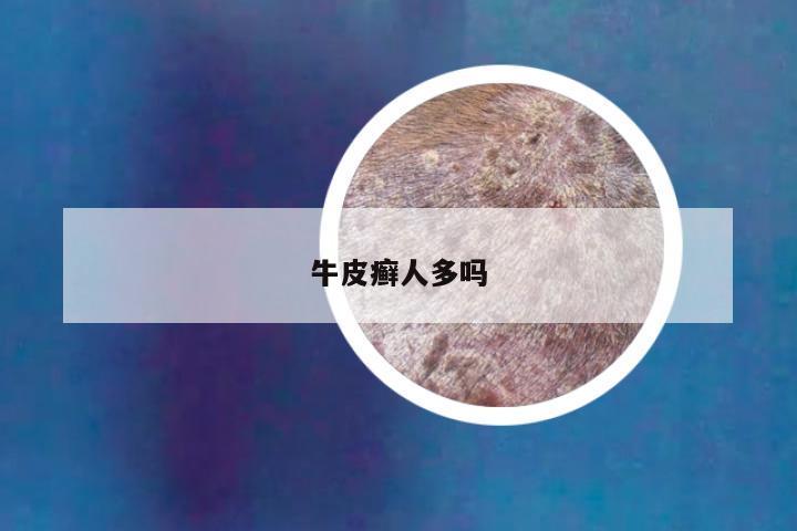 牛皮癣人多吗