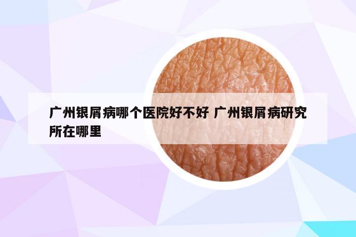 广州银屑病哪个医院好不好 广州银屑病研究所在哪里
