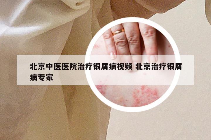 北京中医医院治疗银屑病视频 北京治疗银屑病专家