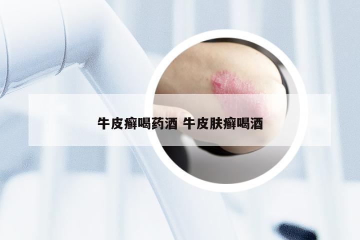 牛皮癣喝药酒 牛皮肤癣喝酒