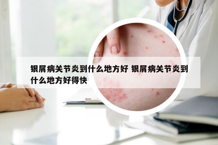 银屑病关节炎到什么地方好 银屑病关节炎到什么地方好得快
