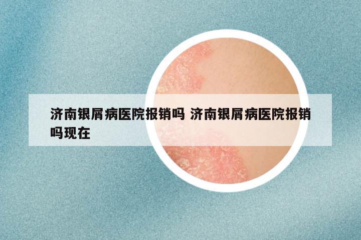 济南银屑病医院报销吗 济南银屑病医院报销吗现在