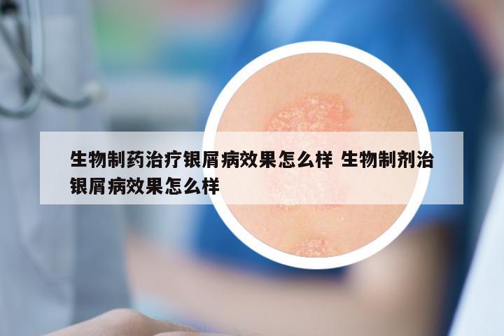 生物制药治疗银屑病效果怎么样 生物制剂治银屑病效果怎么样