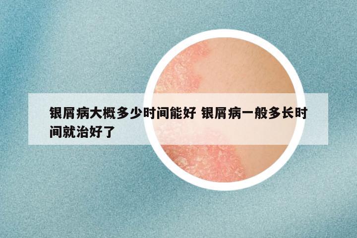 银屑病大概多少时间能好 银屑病一般多长时间就治好了