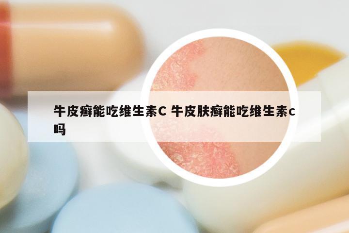 牛皮癣能吃维生素C 牛皮肤癣能吃维生素c吗