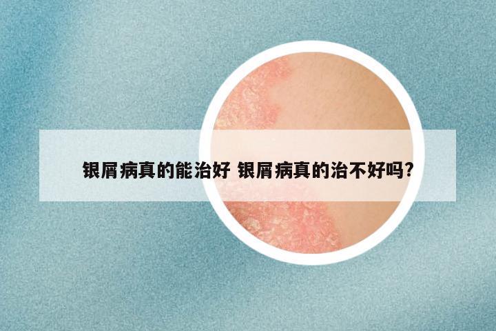 银屑病真的能治好 银屑病真的治不好吗?