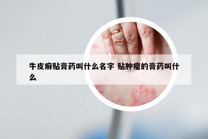 牛皮癣贴膏药叫什么名字 贴肿瘤的膏药叫什么