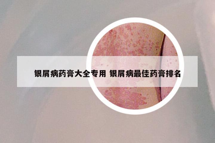 银屑病药膏大全专用 银屑病最佳药膏排名