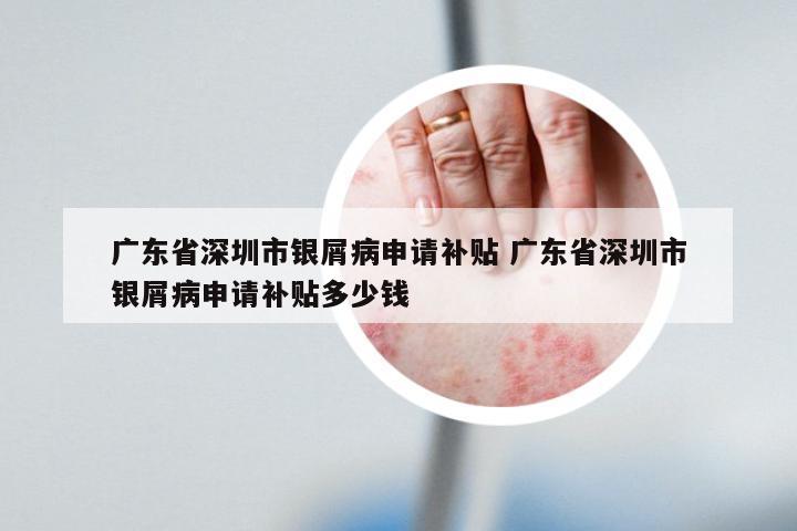 广东省深圳市银屑病申请补贴 广东省深圳市银屑病申请补贴多少钱