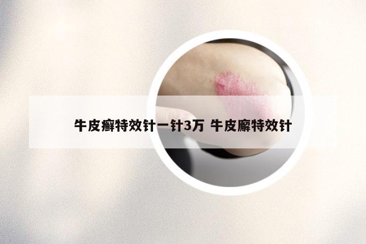 牛皮癣特效针一针3万 牛皮廨特效针