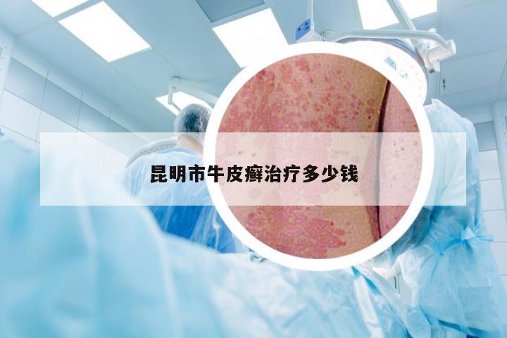 昆明市牛皮癣治疗多少钱