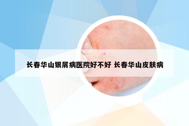 长春华山银屑病医院好不好 长春华山皮肤病