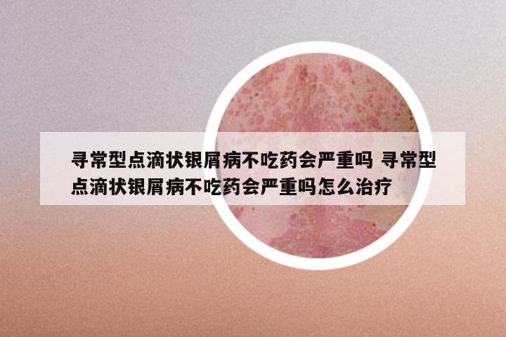 寻常型点滴状银屑病不吃药会严重吗 寻常型点滴状银屑病不吃药会严重吗怎么治疗
