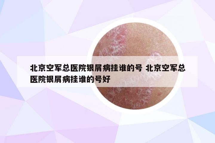 北京空军总医院银屑病挂谁的号 北京空军总医院银屑病挂谁的号好