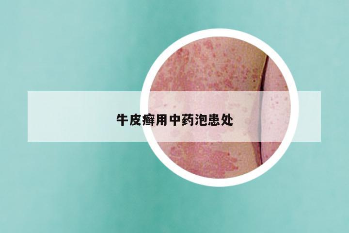 牛皮癣用中药泡患处