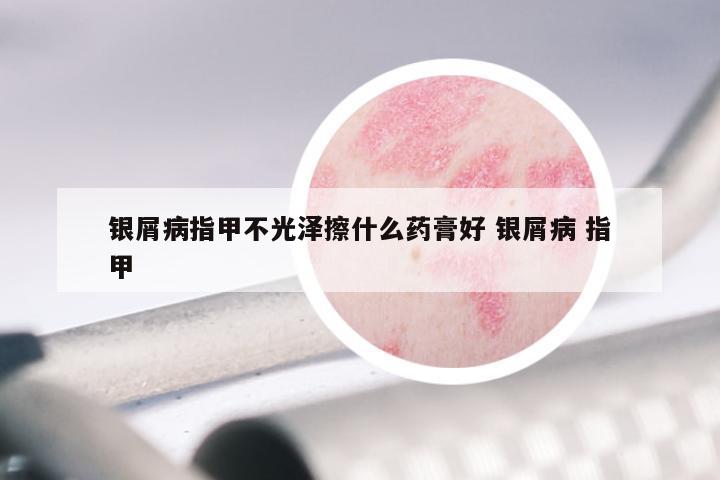 银屑病指甲不光泽擦什么药膏好 银屑病 指甲