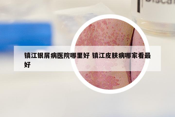 镇江银屑病医院哪里好 镇江皮肤病哪家看最好