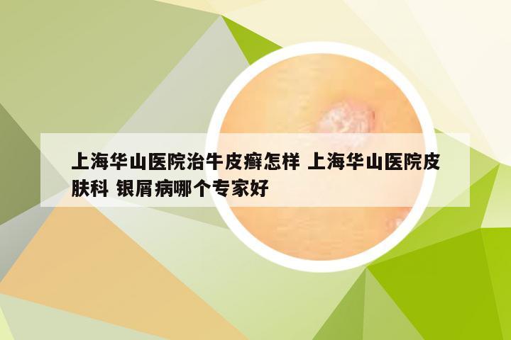 上海华山医院治牛皮癣怎样 上海华山医院皮肤科 银屑病哪个专家好