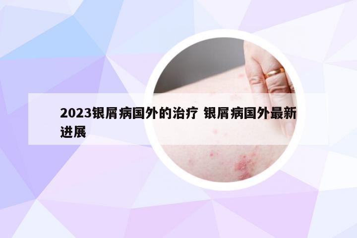 2023银屑病国外的治疗 银屑病国外最新进展