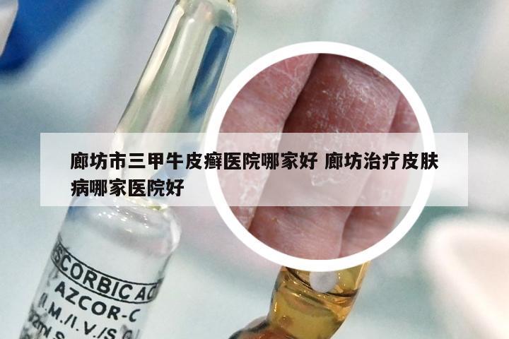 廊坊市三甲牛皮癣医院哪家好 廊坊治疗皮肤病哪家医院好