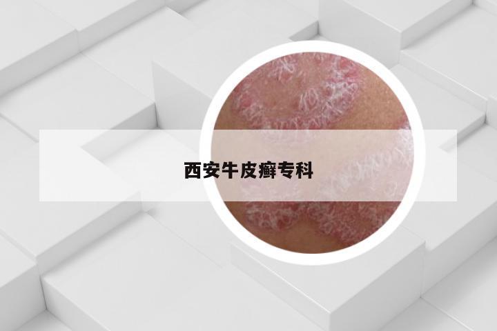 西安牛皮癣专科