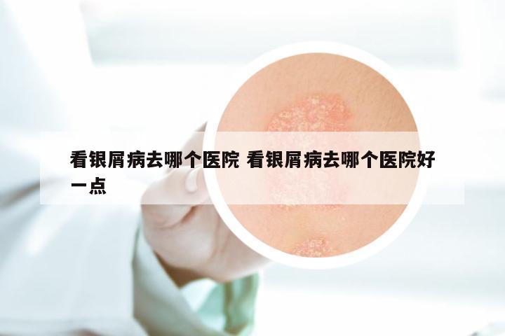 看银屑病去哪个医院 看银屑病去哪个医院好一点