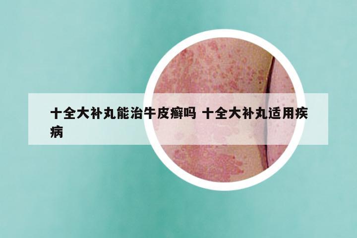 十全大补丸能治牛皮癣吗 十全大补丸适用疾病