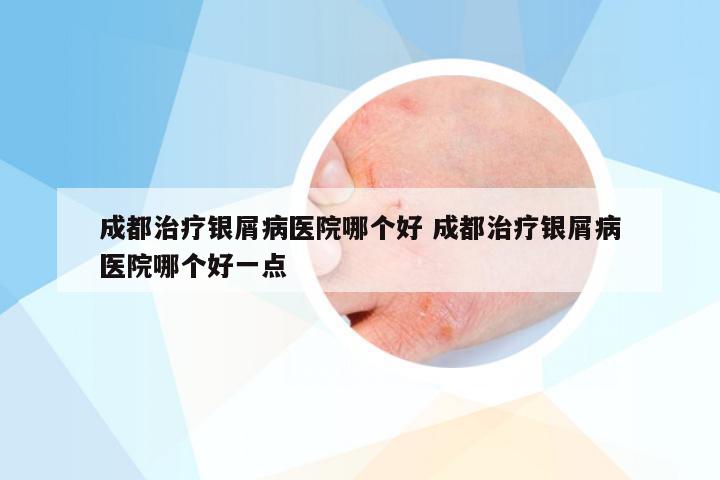 成都治疗银屑病医院哪个好 成都治疗银屑病医院哪个好一点