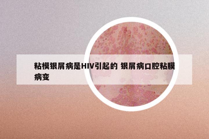 粘模银屑病是HIV引起的 银屑病口腔粘膜病变