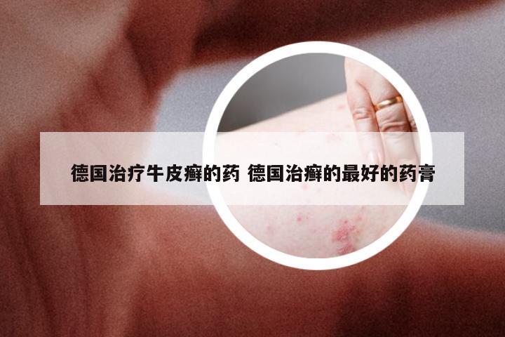 德国治疗牛皮癣的药 德国治癣的最好的药膏