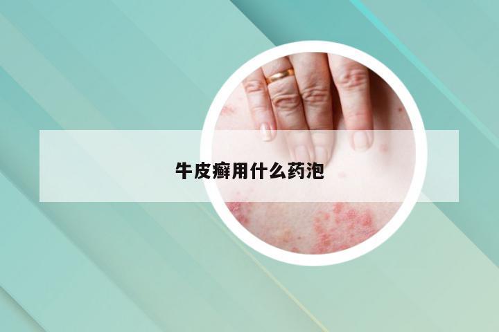 牛皮癣用什么药泡