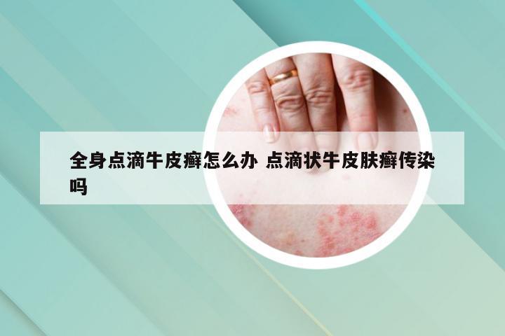 全身点滴牛皮癣怎么办 点滴状牛皮肤癣传染吗
