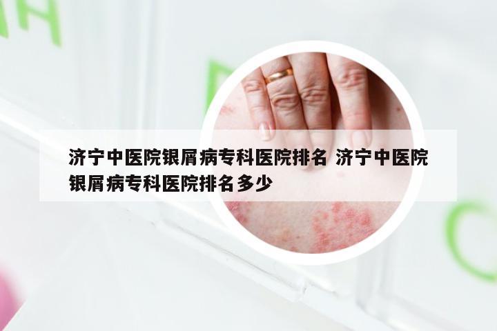 济宁中医院银屑病专科医院排名 济宁中医院银屑病专科医院排名多少