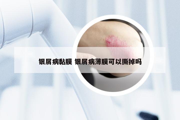 银屑病黏膜 银屑病薄膜可以撕掉吗