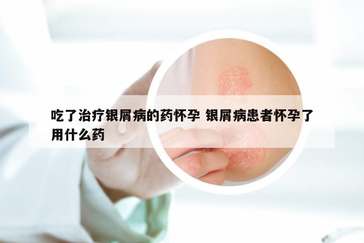 吃了治疗银屑病的药怀孕 银屑病患者怀孕了用什么药