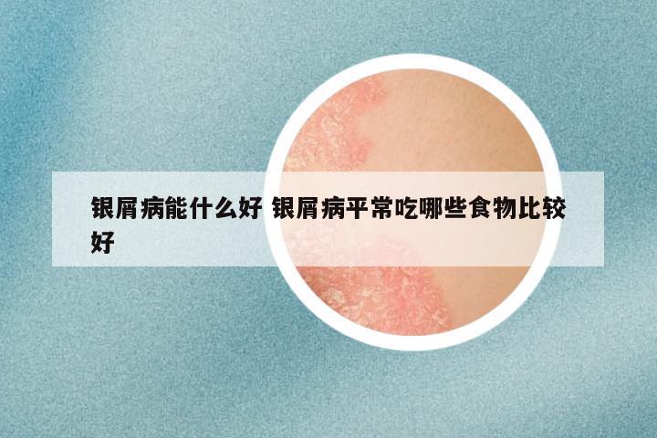 银屑病能什么好 银屑病平常吃哪些食物比较好
